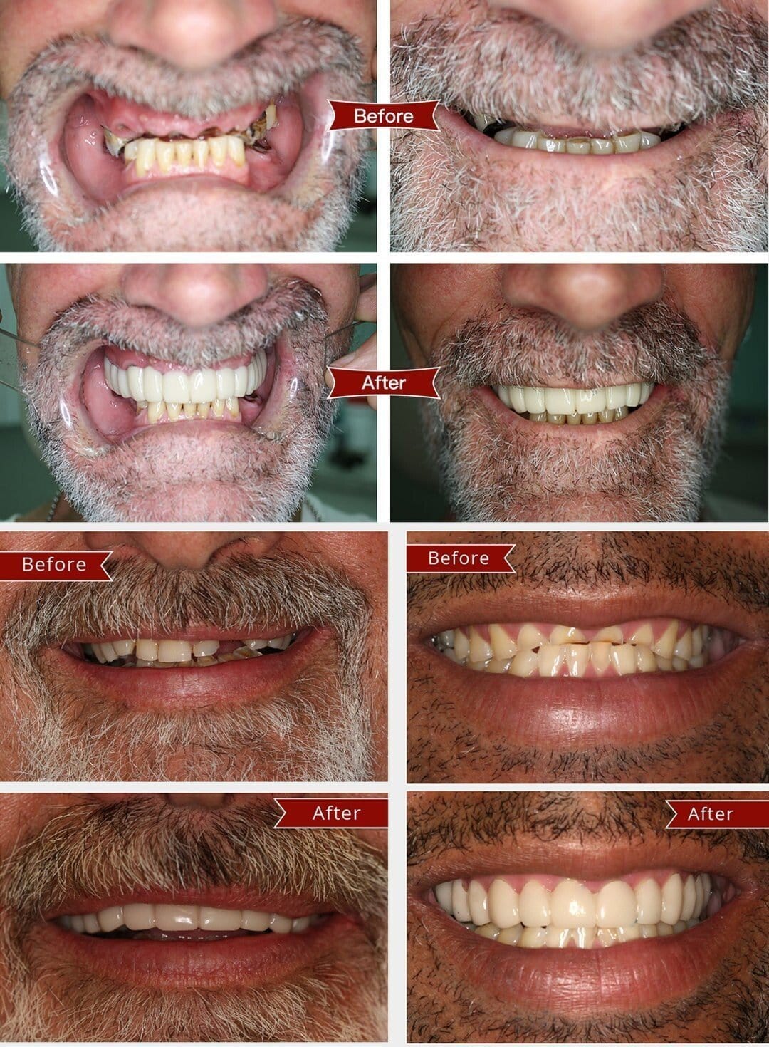Ezysmyl™️ Snap-On Dentures
