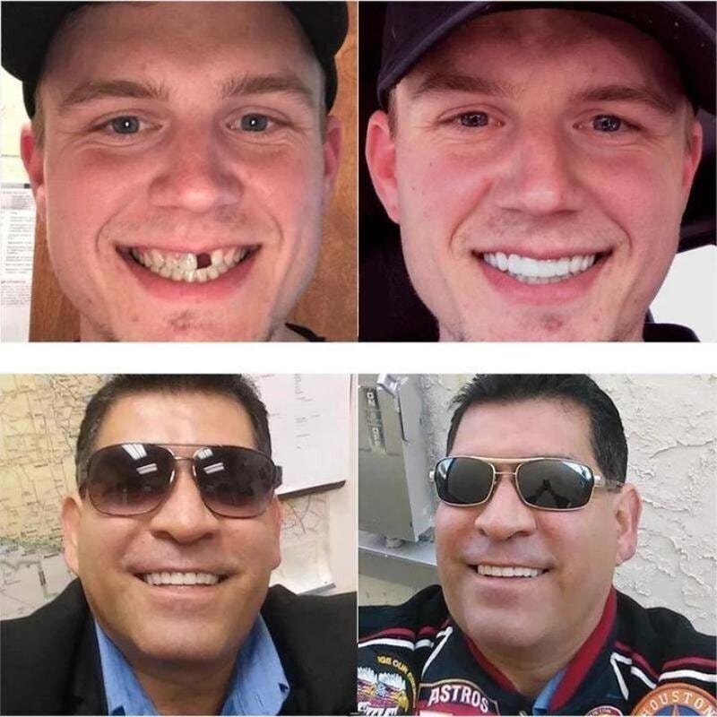 Ezysmyl™️ Snap-On Dentures